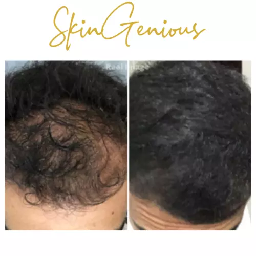 Best PRP hair treatment Treatment in Mumbai with Latest Prices Top